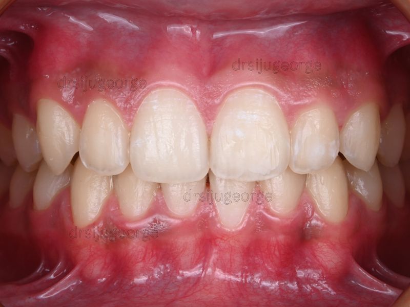 After Invisalign Teen: straightened teeth, 28 months, Dr. Siju George Muscat