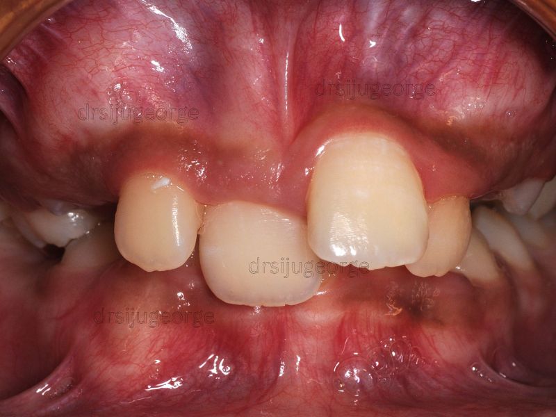 Before Invisalign: teen crowding before treatment, Muscat Oman