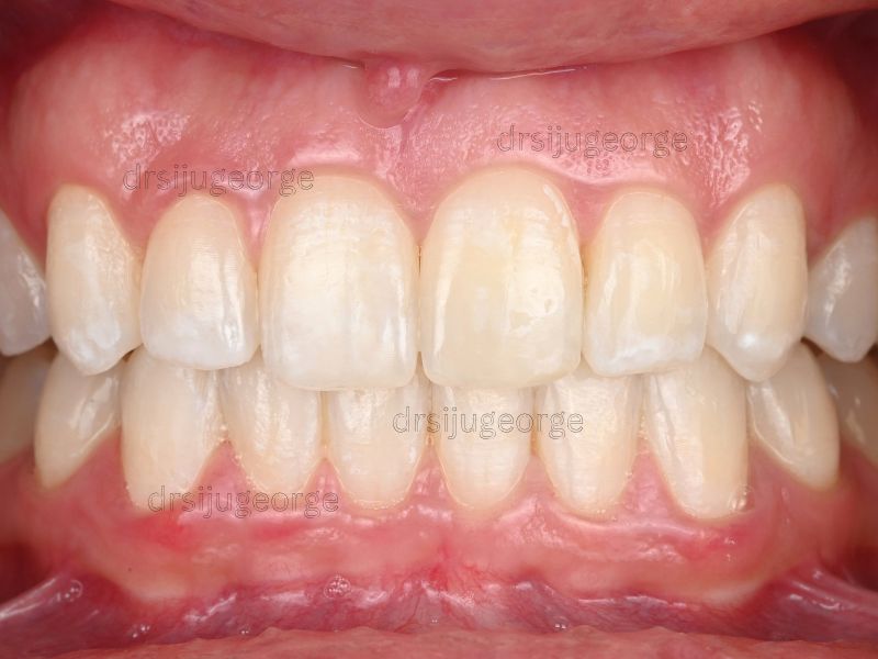 After Invisalign: underbite resolved in 14 months treatment, Dr. Siju George
