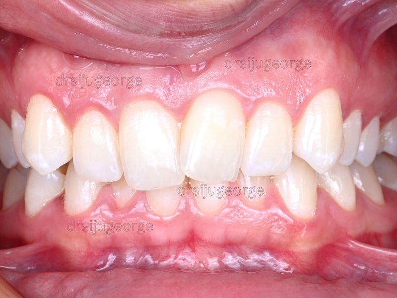 Before Invisalign: underbite case adult patient, Wassan Dental Muscat