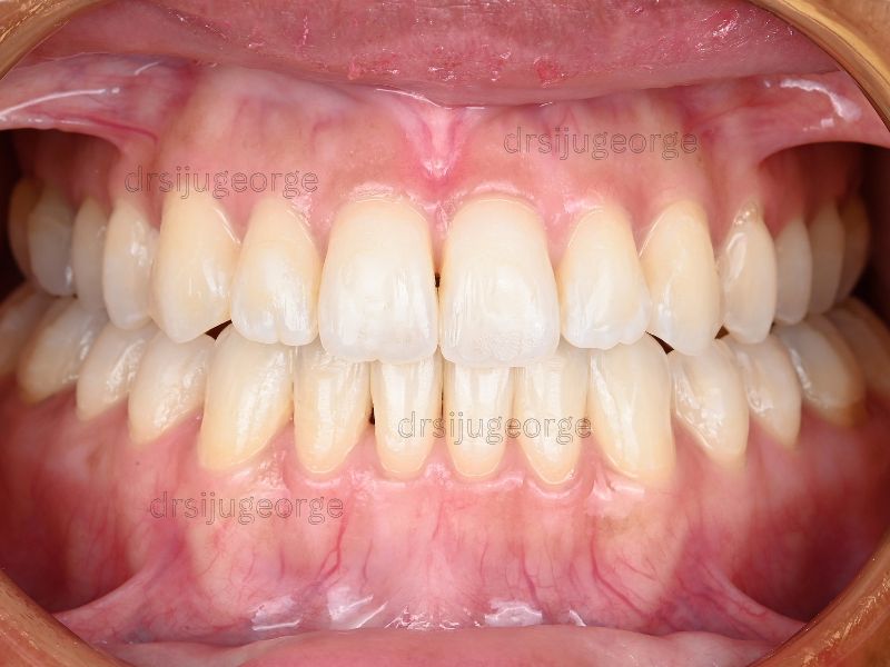 After Invisalign: open bite closed after 20 months, Dr. Siju George Wassan Dental Centre