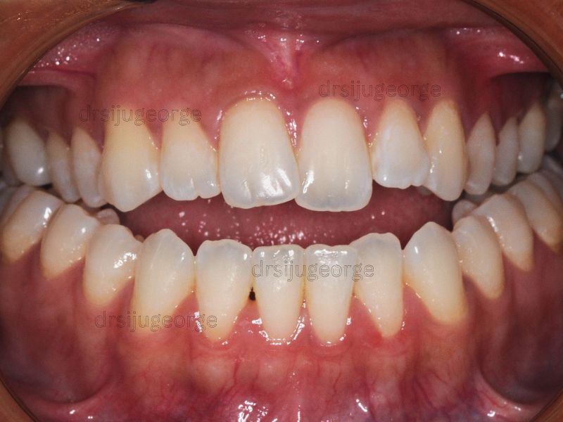 Before Invisalign: open bite in an adult patient, Muscat Oman
