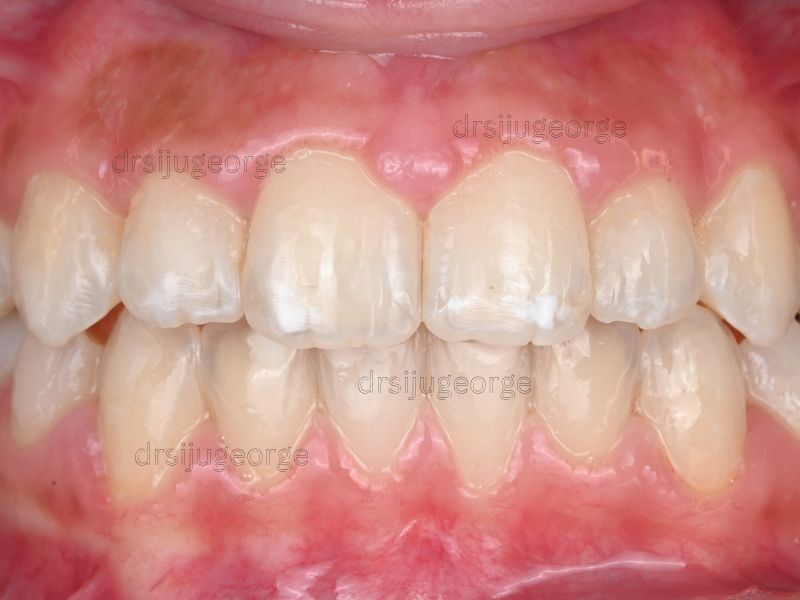 After Invisalign Teen: open bite resolved in 19 months, Dr. Siju George