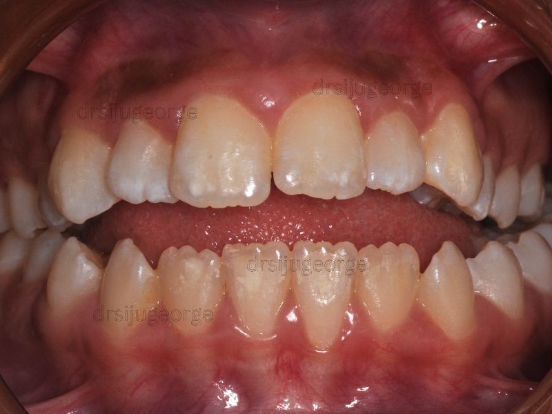 Before Invisalign: open bite in a teen patient, Wassan Dental Muscat