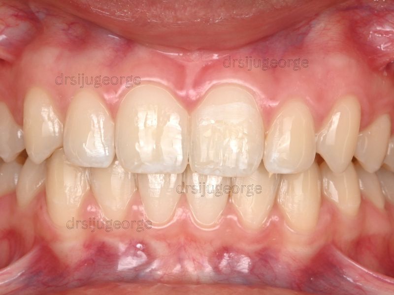 After Invisalign Teen: Class II corrected in 18 months, Dr. Siju George Wassan Dental