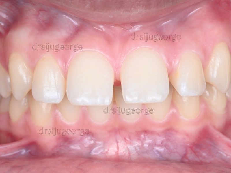 Before Invisalign: Class II malocclusion in a teen patient, Muscat Oman