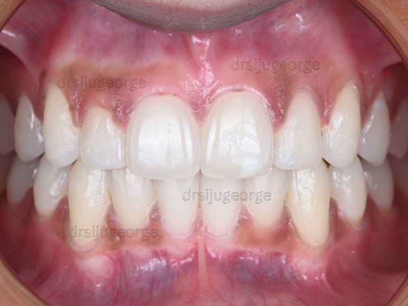 After Invisalign Teen: Class II resolved in 16 months, Dr. Siju George