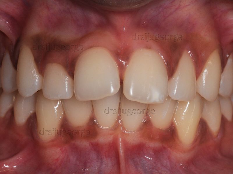 Before Invisalign: Class II bite in teen patient, Wassan Dental Muscat