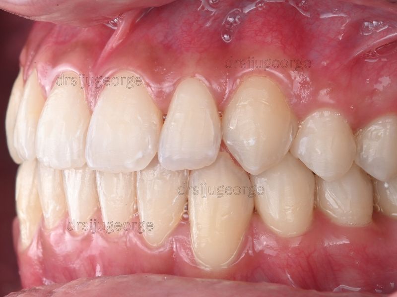 After Invisalign Teen: Class III corrected, 20 months, Dr. Siju George