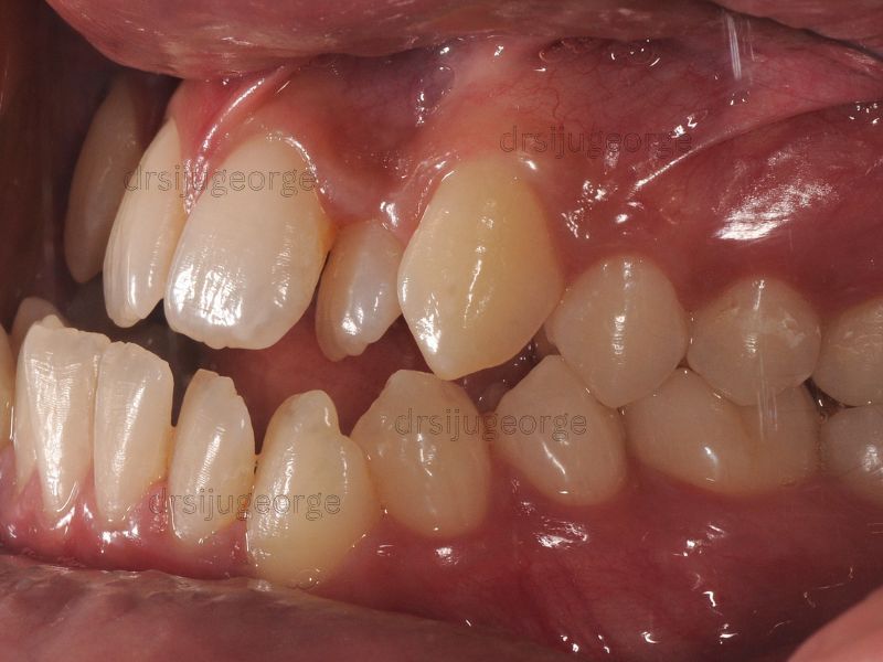 Before Invisalign: Class III malocclusion teen patient, Muscat Oman