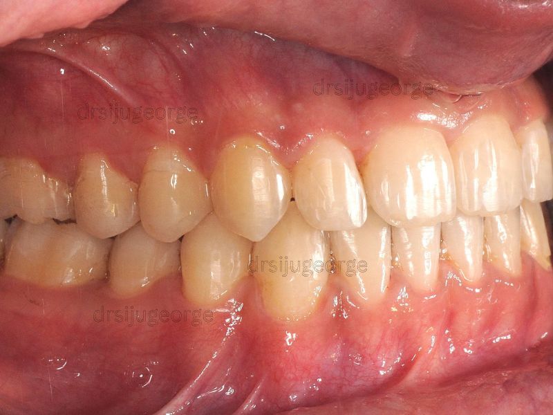 After Invisalign Teen: Class III resolved in 20 months treatment, Dr. Siju George