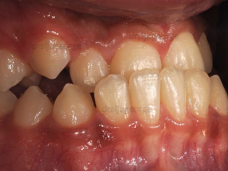 Before Invisalign: Class III bite in teen patient, Wassan Dental Muscat