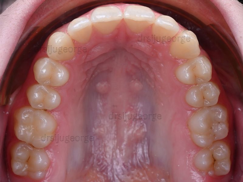 After Invisalign Comprehensive: arch expansion achieved in a teen patient in 13 months, Dr. Siju George