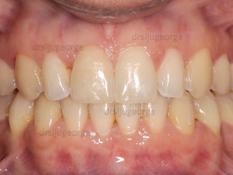 After Invisalign Comprehensive: spacing corrected in 15 months, Dr. Siju George Wassan Dental Centre