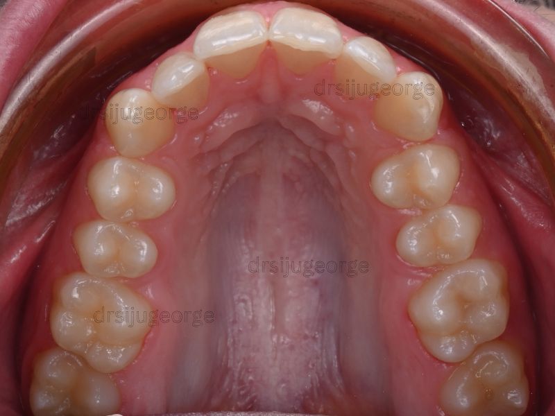 Before Invisalign: narrow dental arches in a teen patient, Wassan Dental Muscat