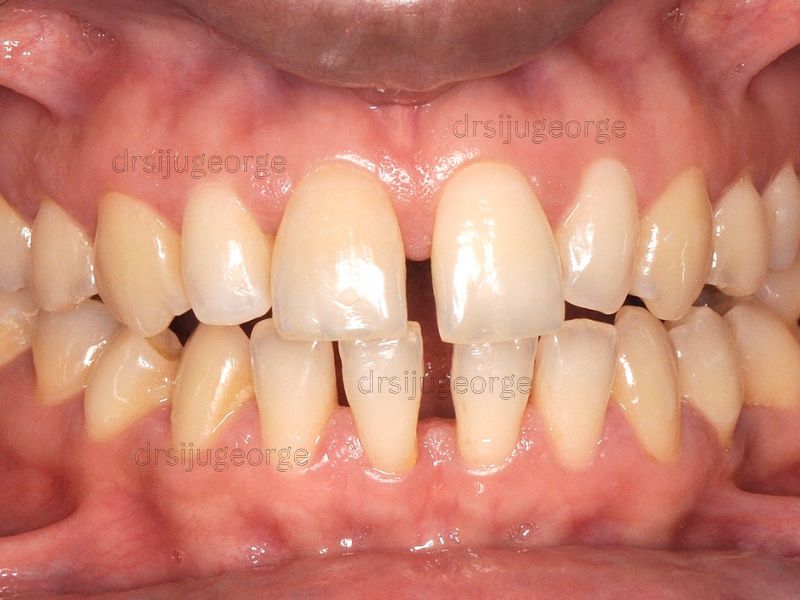 Before Invisalign: dental spacing in an adult patient, Muscat Oman