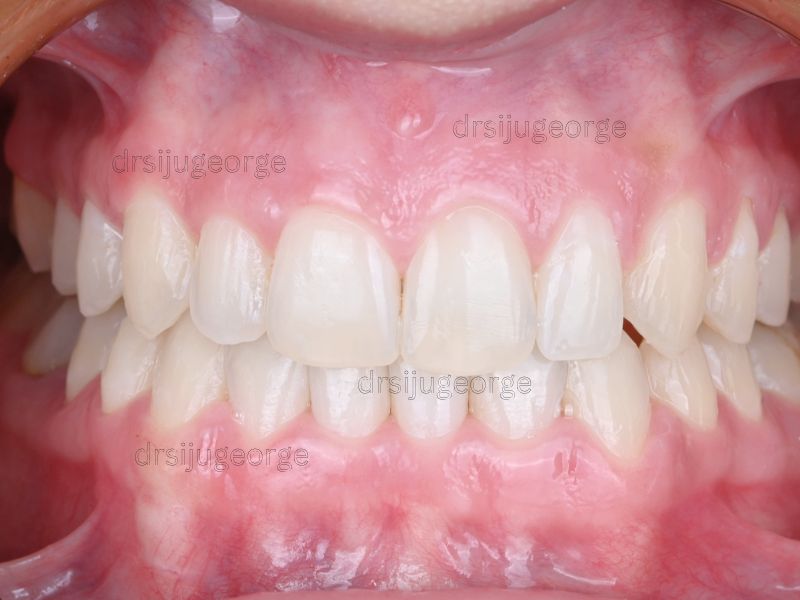 After Invisalign Comprehensive: crossbite corrected in 16 months, Dr. Siju George