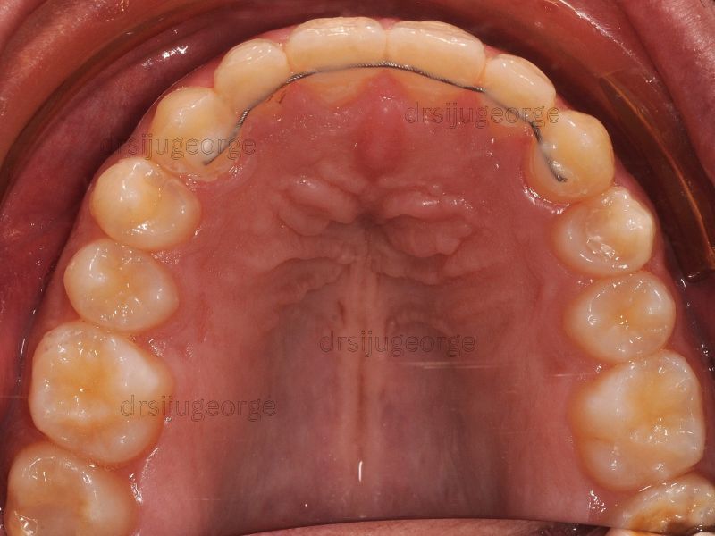 After Invisalign Comprehensive: comprehensive arch expansion in a teen patient in 18 months, Dr. Siju George Wassan Dental Centre
