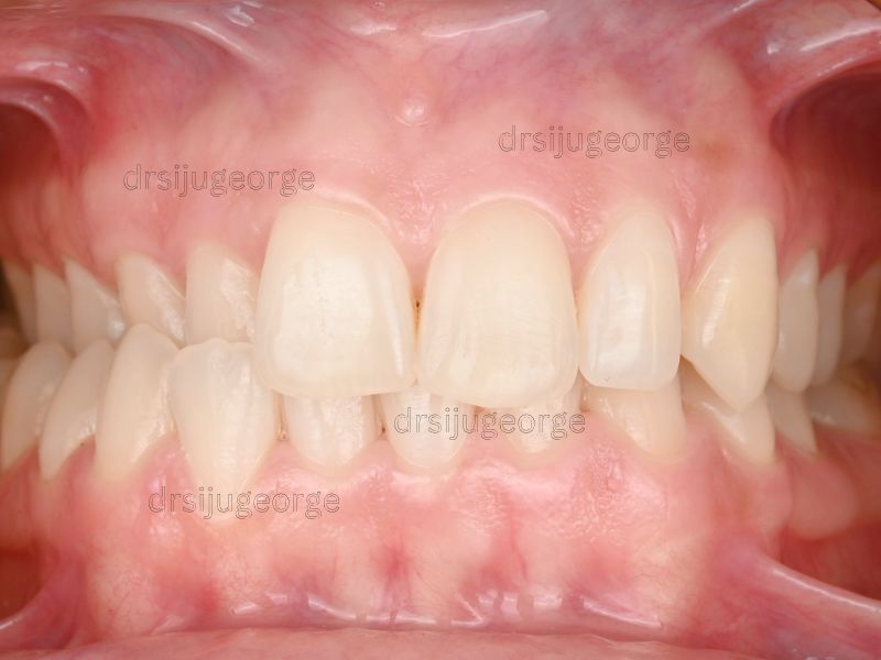 Before Invisalign: crossbite in an adult patient, Wassan Dental Muscat
