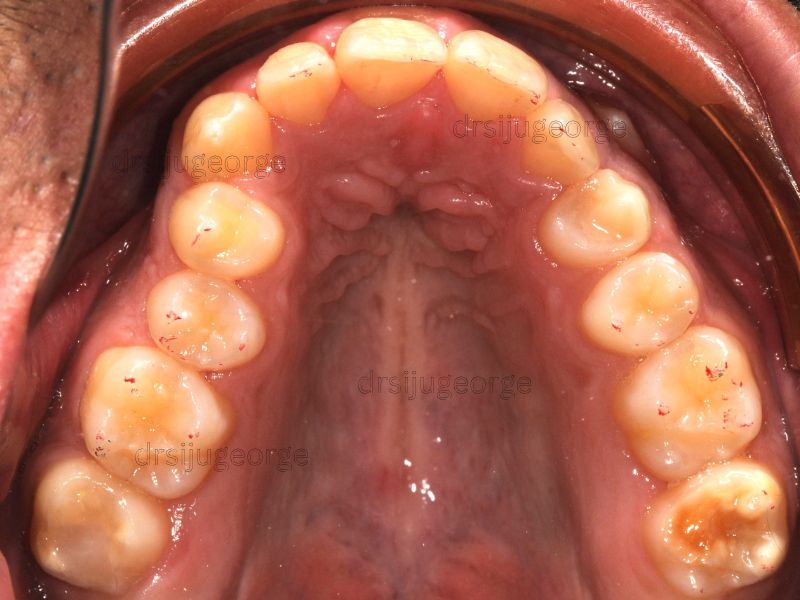 Before Invisalign: narrow dental arches in a teen patient, Muscat Oman
