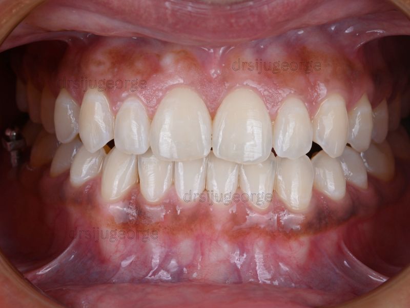 After Invisalign Comprehensive: underbite corrected in 30 months, Dr. Siju George