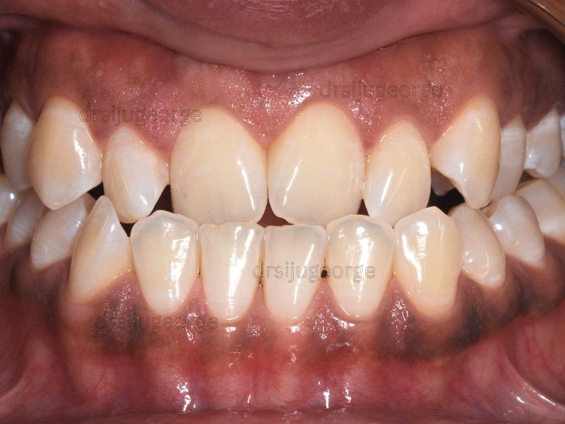 Before Invisalign: underbite in an adult patient, Muscat Oman