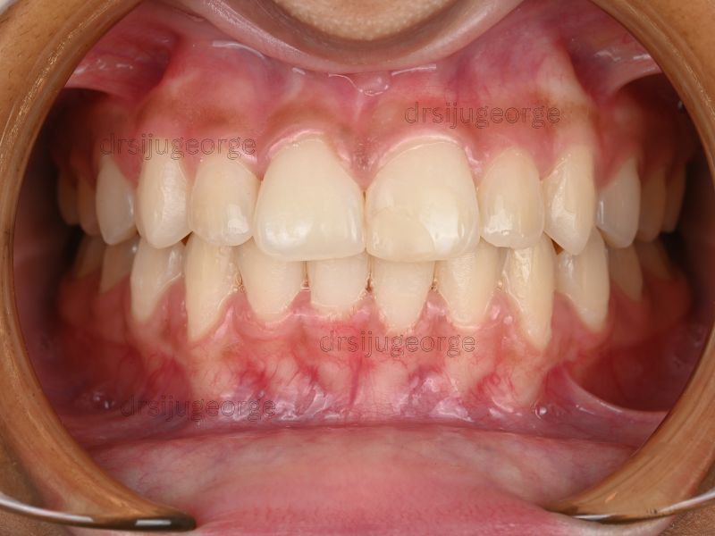 After Invisalign Teen: straightened smile after 22 months at Wassan Dental Centre