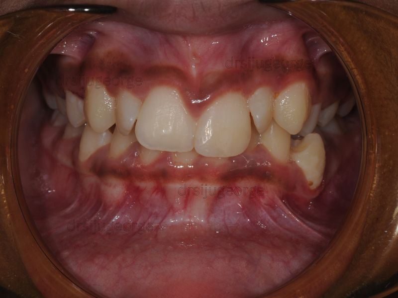 Before Invisalign: moderate crowding in a teen patient, Muscat