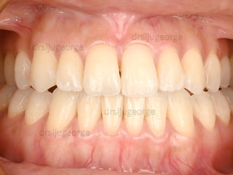 After Invisalign Comprehensive: open bite corrected in 24 months, Dr. Siju George