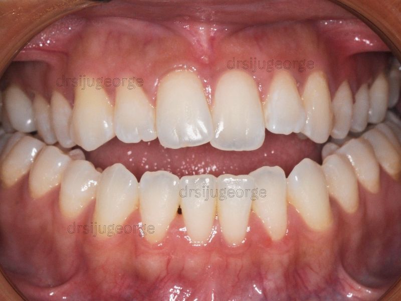 Before Invisalign: open bite in an adult patient, Wassan Dental Muscat
