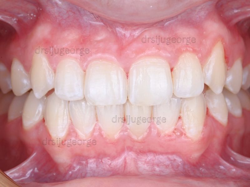 After Invisalign Comprehensive: Class II deep bite corrected in 21 months, Dr. Siju George
