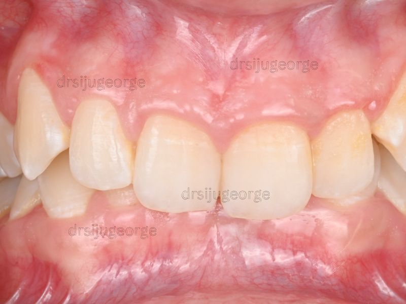 Before Invisalign: Class II deep bite in an adult patient, Muscat Oman
