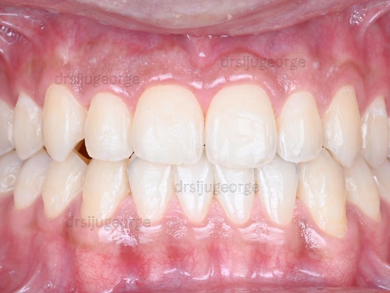 After Invisalign Comprehensive: Class III corrected in 16 months, Dr. Siju George