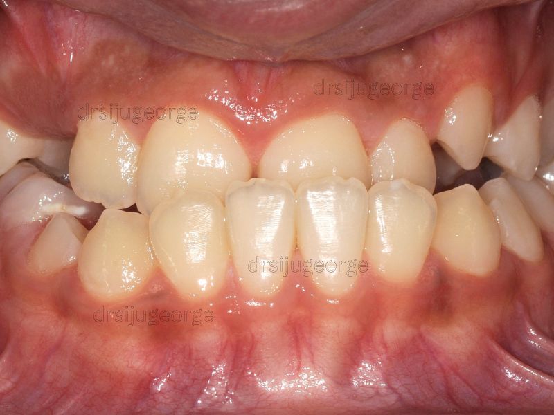 Before Invisalign: Class III bite in an adult patient, Wassan Dental Muscat