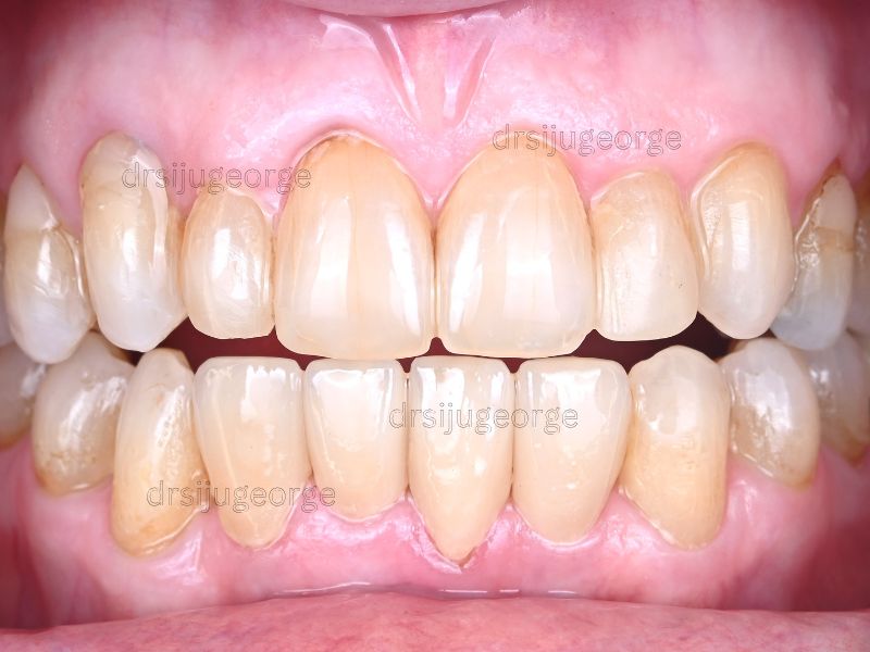 After Invisalign Comprehensive: crowding resolved in 12 months, Dr. Siju George