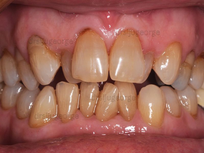 Before Invisalign: crowding in an older adult patient, Muscat Oman
