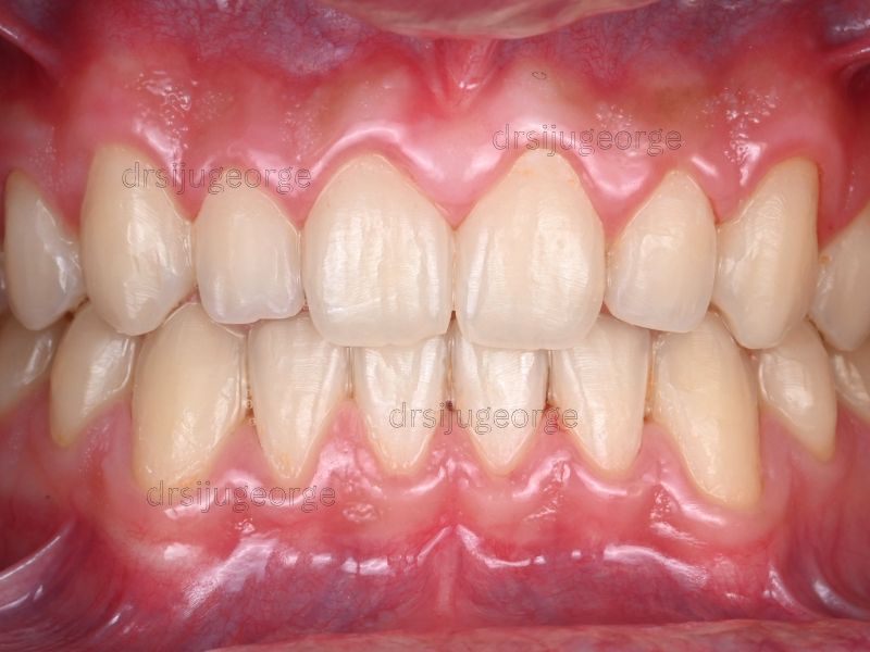 After Invisalign Teen: gaps closed, 14 months, Dr. Siju George Wassan Dental