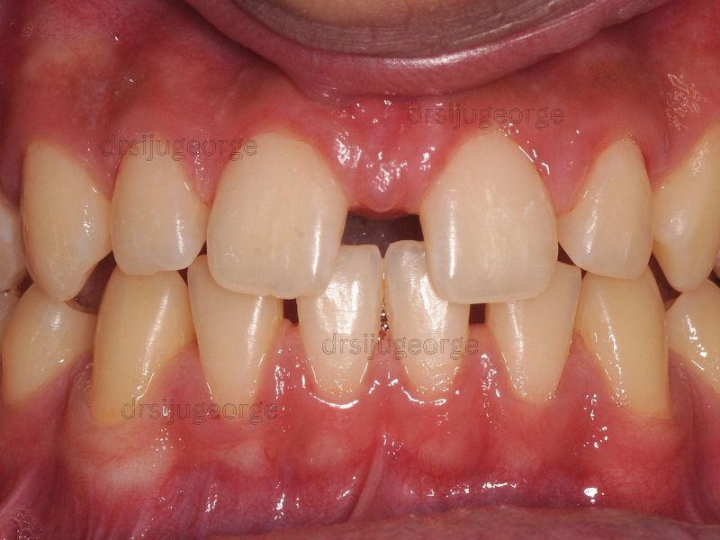 Before Invisalign: teen spacing and gaps before treatment, Muscat