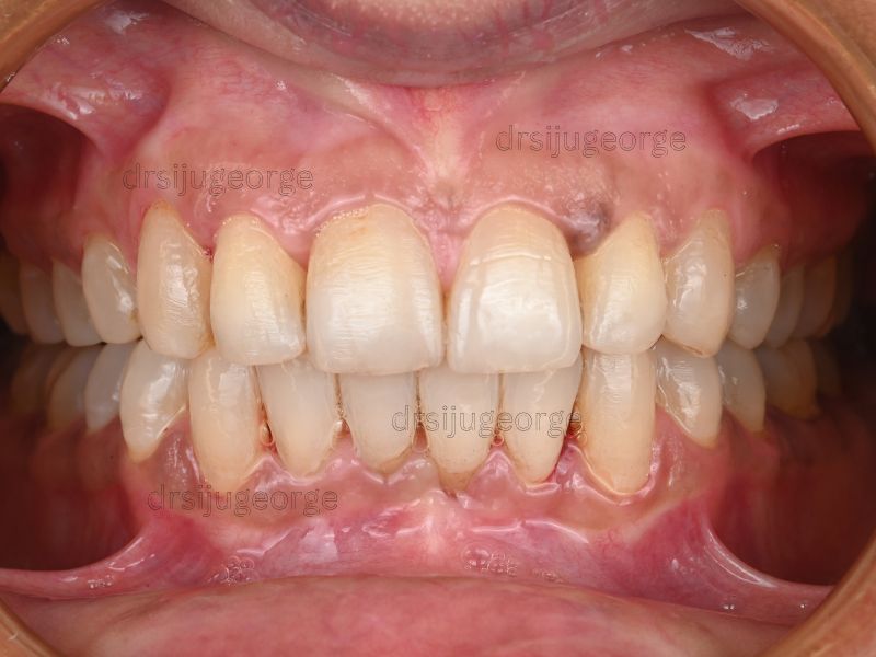 After Invisalign Comprehensive: spacing corrected in 16 months at Wassan Dental Centre