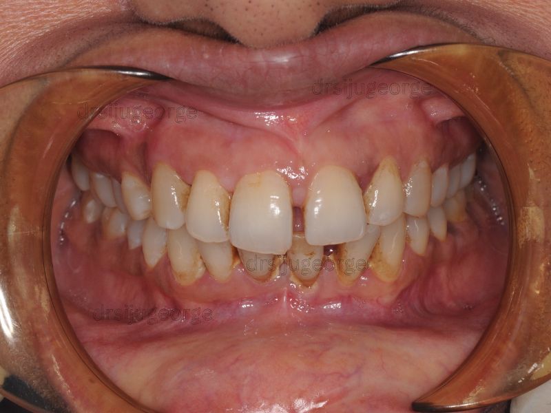 Before Invisalign: dental spacing in an adult patient, Muscat Oman