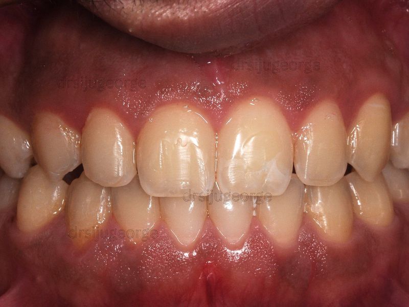 After Invisalign: arch expansion achieved in 18 months, Dr. Siju George Wassan Dental