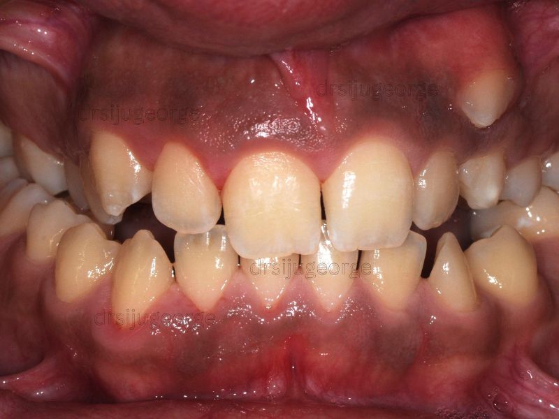 Before Invisalign: narrow dental arches in an adult patient, Muscat