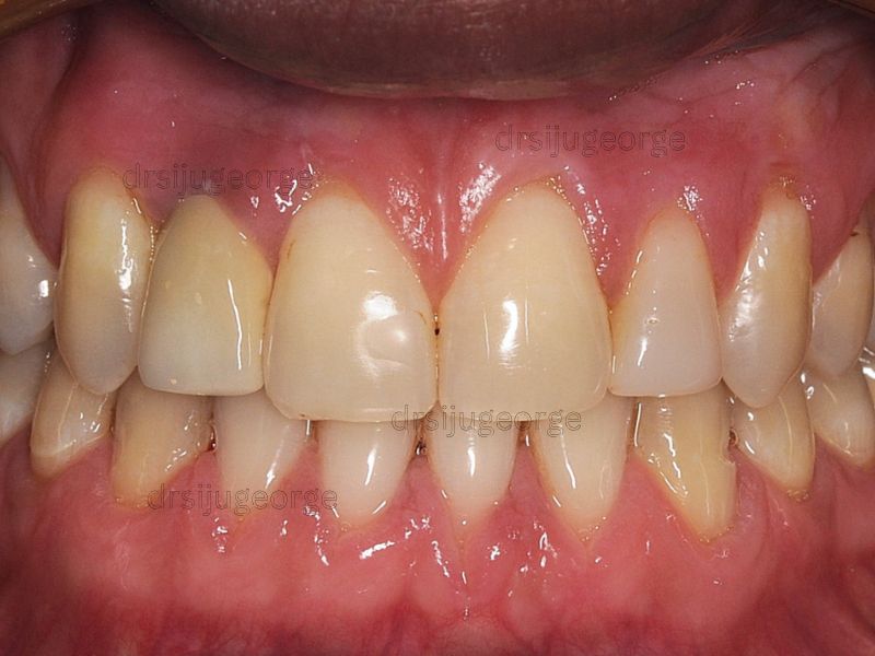 After Invisalign: crossbite corrected in 18 months by Dr. Siju George, Muscat