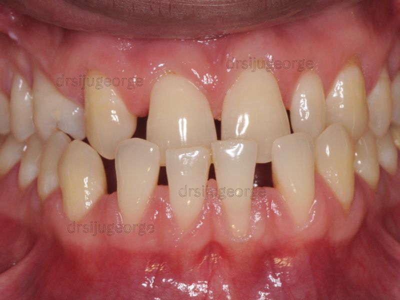 Before Invisalign: crossbite in an adult patient, Muscat Oman