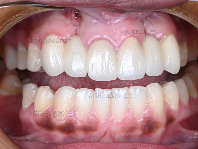 After Invisalign: crossbite fully resolved after 18 months treatment, Dr. Siju George