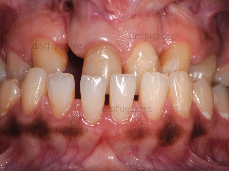 Before Invisalign: crossbite case in adult patient, Wassan Dental Muscat