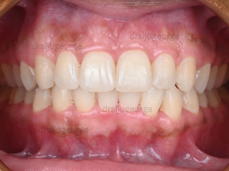 After Invisalign: underbite corrected in just 13 months, Dr. Siju George Wassan Dental
