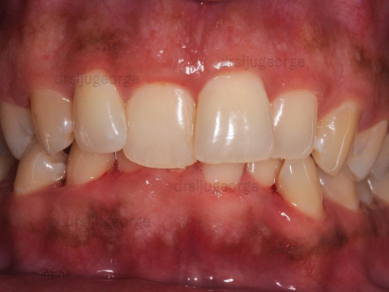 Before Invisalign: underbite in an adult patient, Muscat Oman